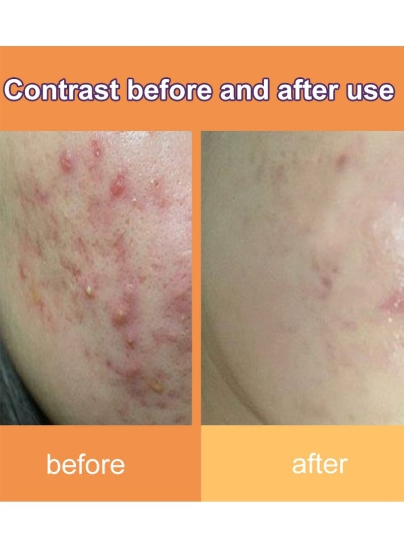 DERMFREE Acne Cream 20g, Soothes Face & Reduces Blackheads, adapalene gel for benzoyl peroxide, Pimples & Blemishes | Oil Control & Redness Relief for Sensitive, Oily & Acne-Prone Skin - Image 5